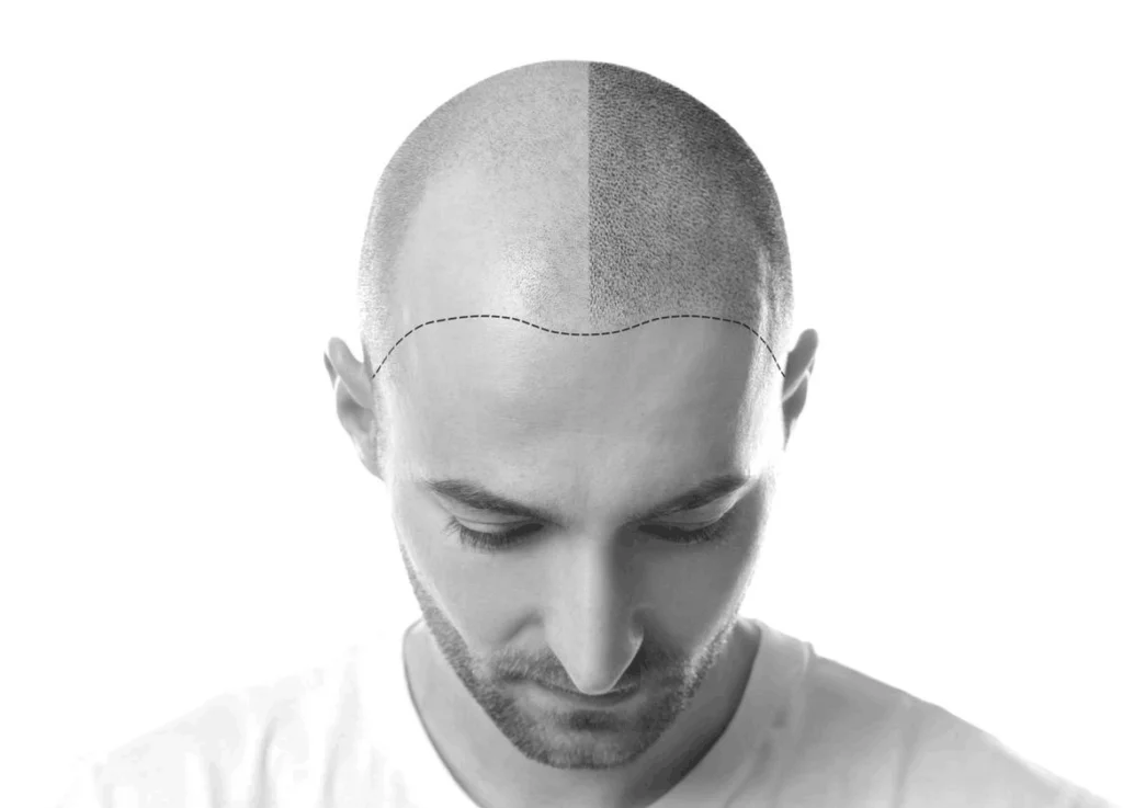 före och efter scalp micropigmentation